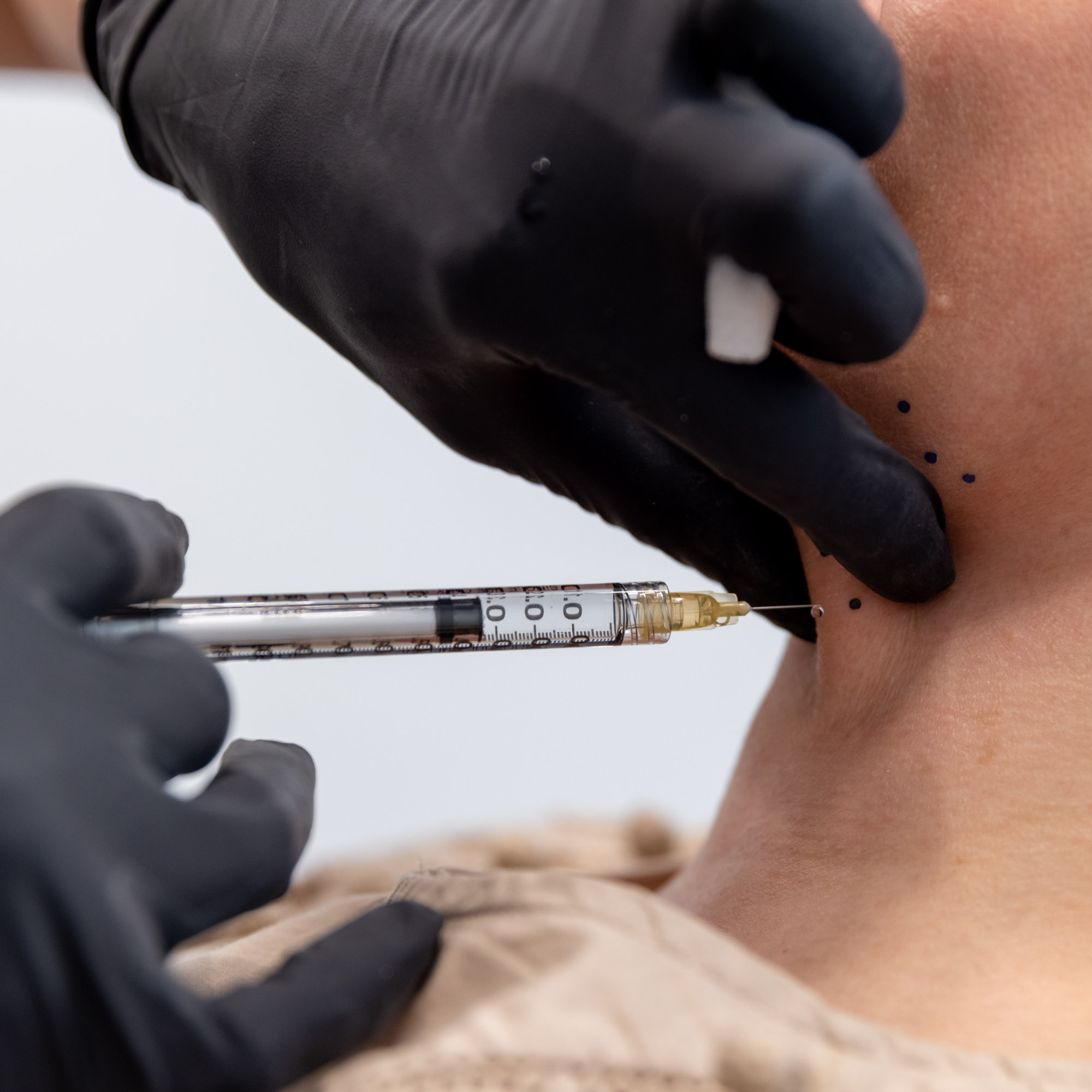 Provider injecting Kybella under a patient's chin along mapped guide dots during Kybella near Chicago at ReJenerate Aesthetic Studio.