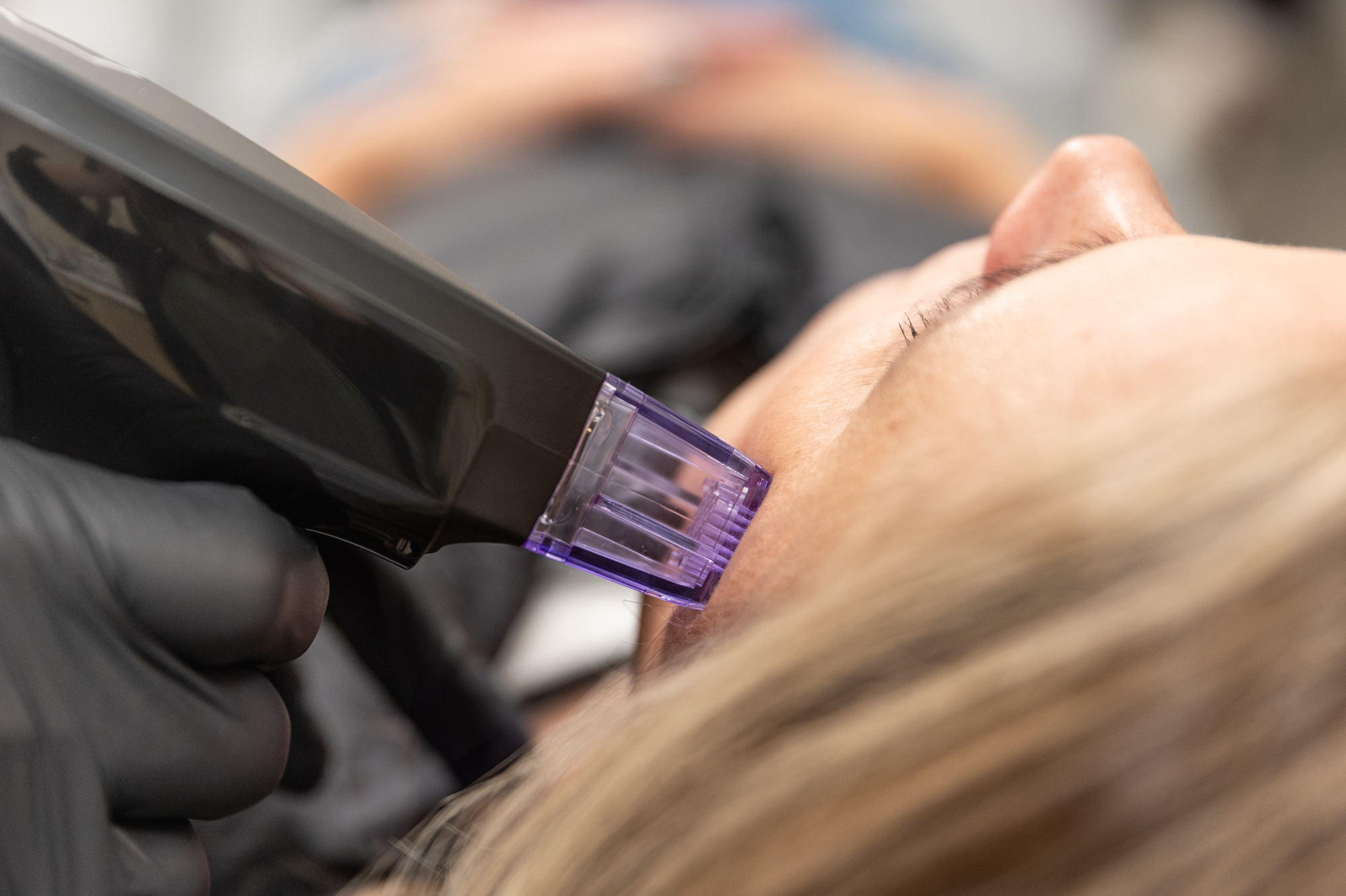 Close-up of a Morpheus8 RF microneedling handpiece on a patient's forehead during an appointment for Morpheus8 near Chicago.